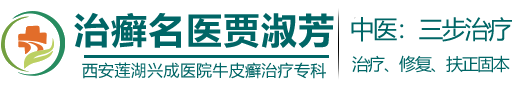 陕西牛皮癣治疗哪家好,西安牛皮癣治疗,陕西牛皮癣治疗，西安兴成牛皮癣医院
